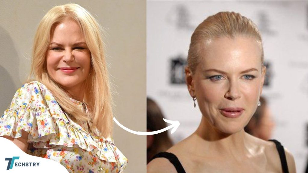 Nicole Kidman's Plastic Surgery